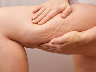 Cellulite Treatments