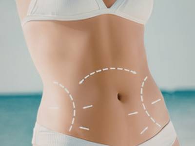 Tummy Tuck